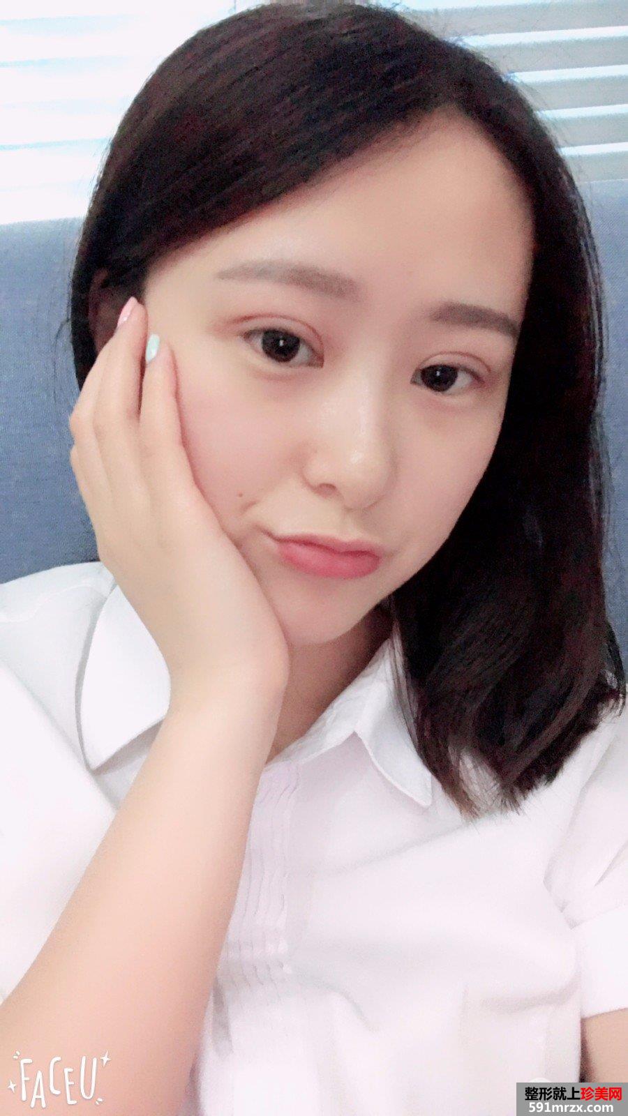 玻尿酸垫下巴+埋线双眼皮案例对比图 立现大眼睛小V脸