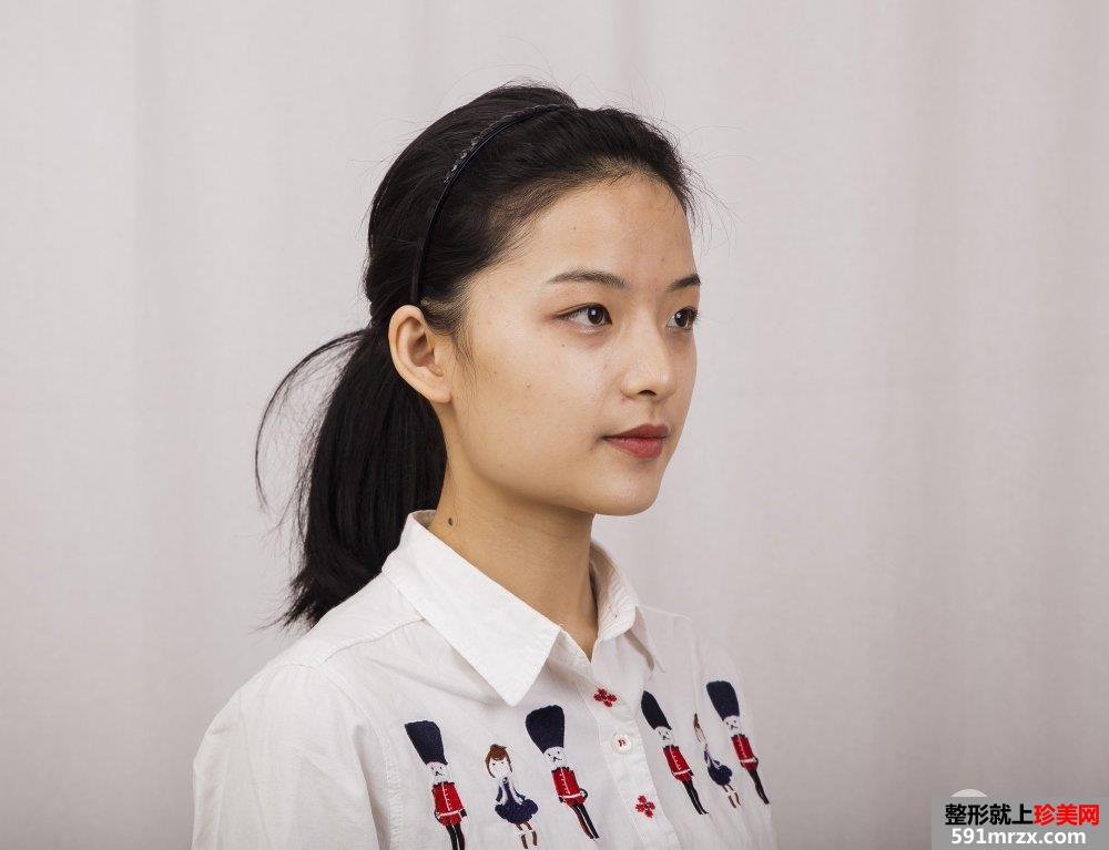 下颌角截骨手术一个月效果 亲身经历有图有真相
