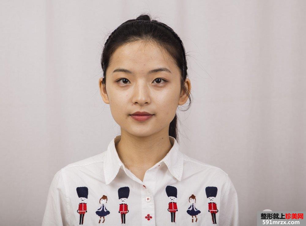 下颌角截骨手术一个月效果 亲身经历有图有真相