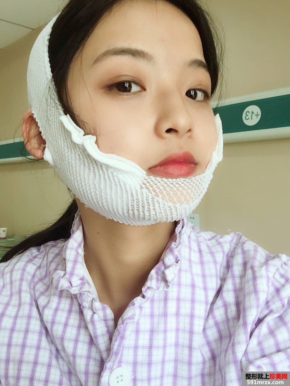 下颌角截骨手术一个月效果 亲身经历有图有真相