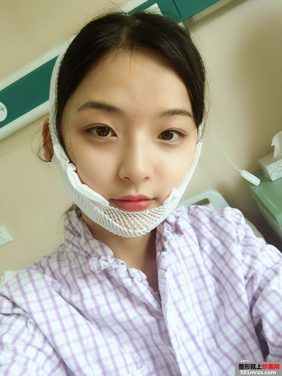 下颌角截骨手术一个月效果 亲身经历有图有真相