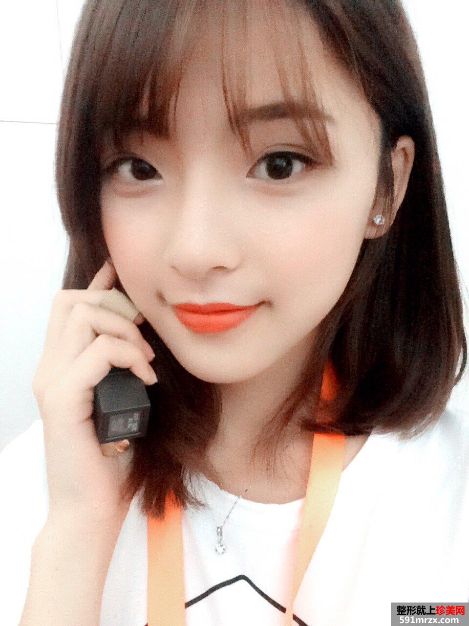 下颌角截骨手术一个月效果 亲身经历有图有真相
