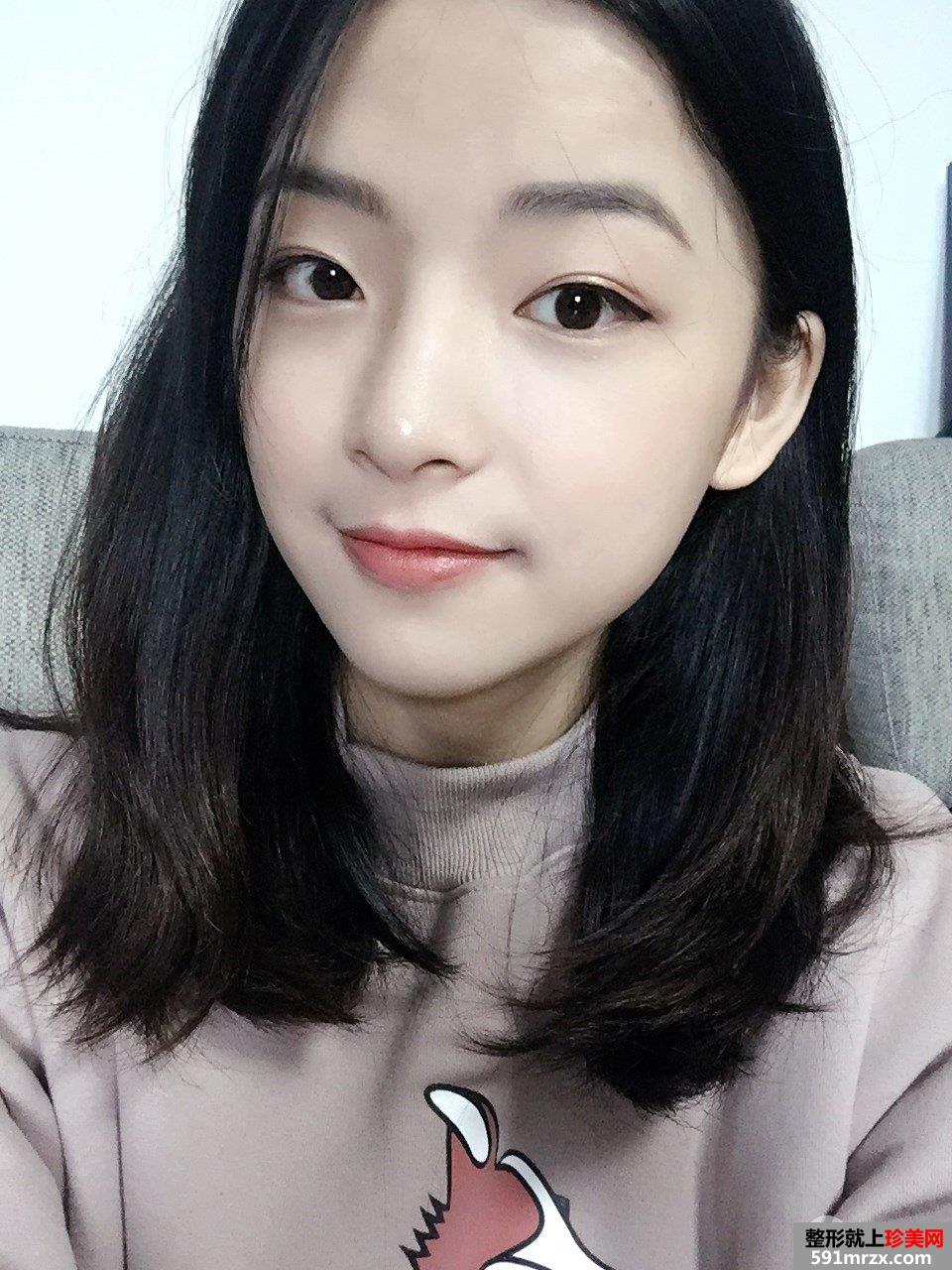 下颌角截骨手术一个月效果 亲身经历有图有真相