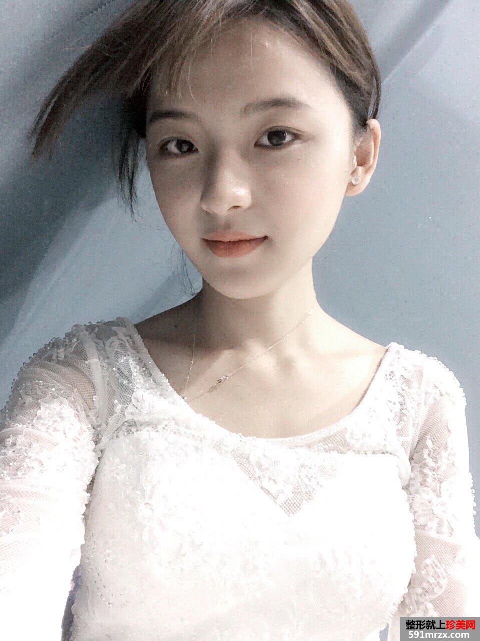 下颌角截骨手术一个月效果 亲身经历有图有真相