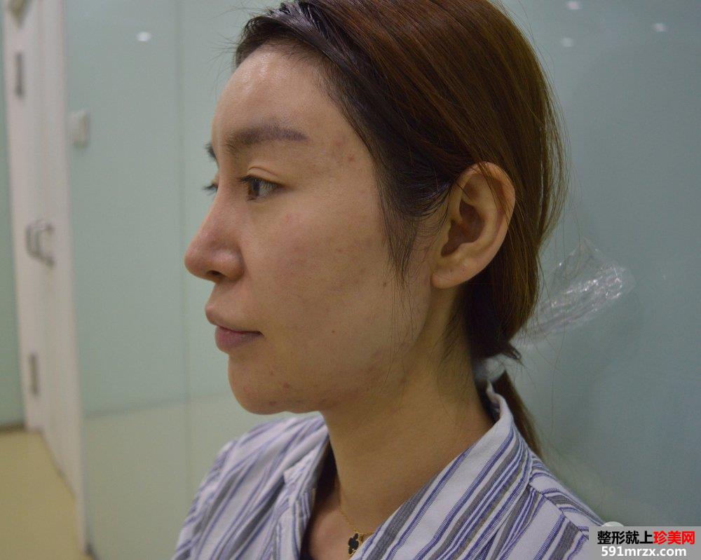 双下巴吸脂真人案例，更多前后对比照片分享
