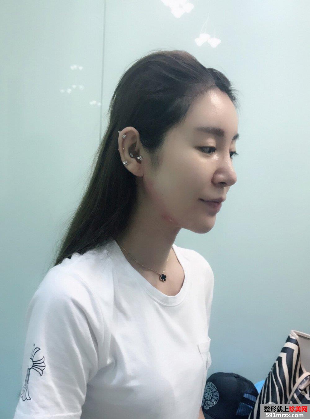 双下巴吸脂真人案例，更多前后对比照片分享