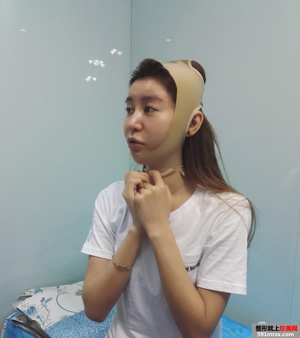 双下巴吸脂真人案例，更多前后对比照片分享