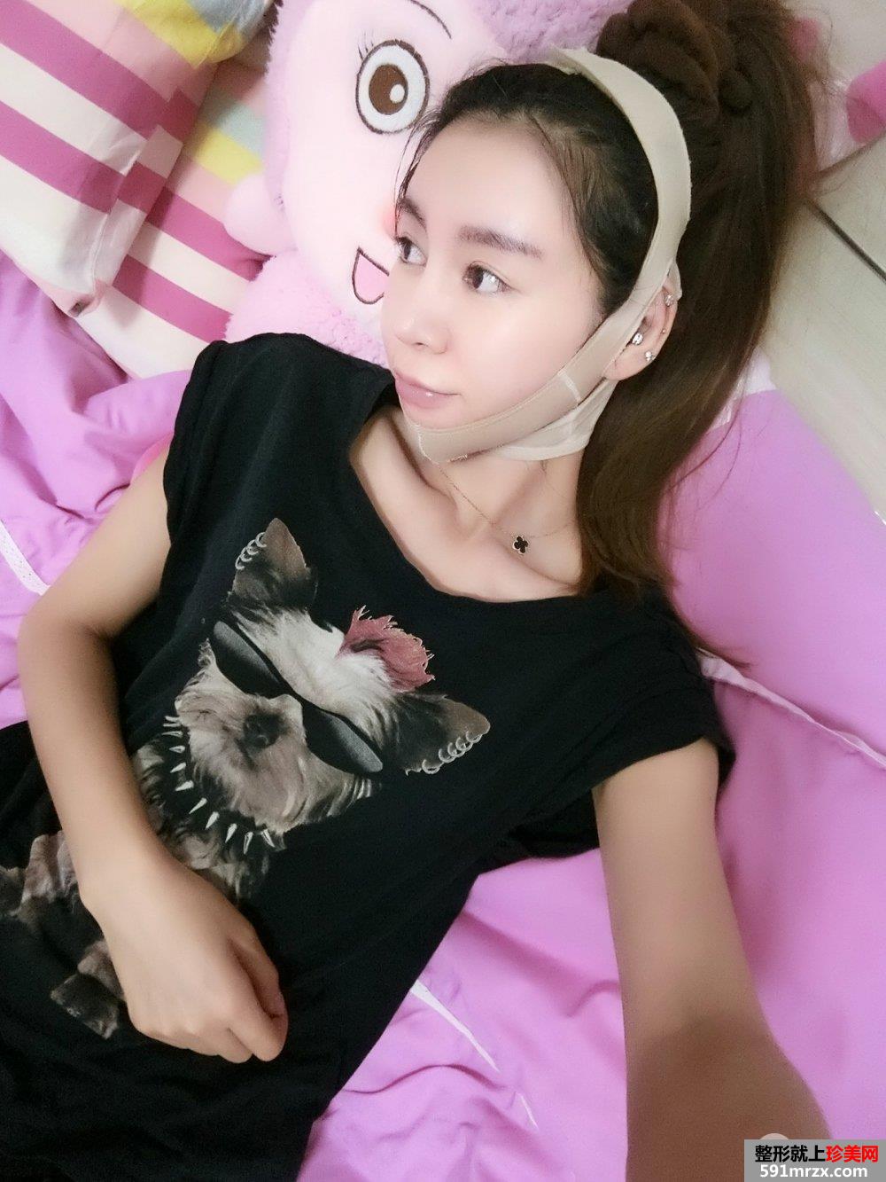 双下巴吸脂真人案例，更多前后对比照片分享