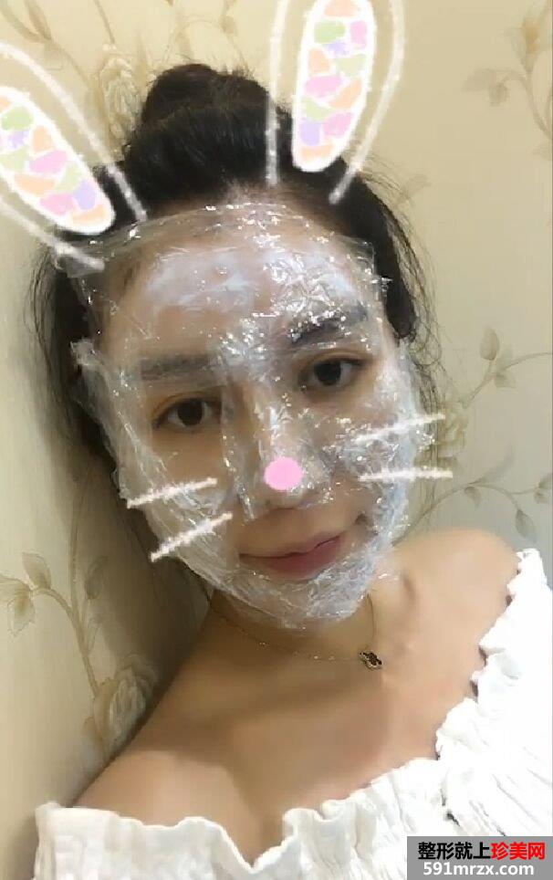 双下巴吸脂真人案例，更多前后对比照片分享