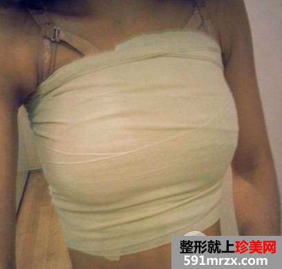 曼托假体隆胸真实案例对比图分享 立现傲人身材