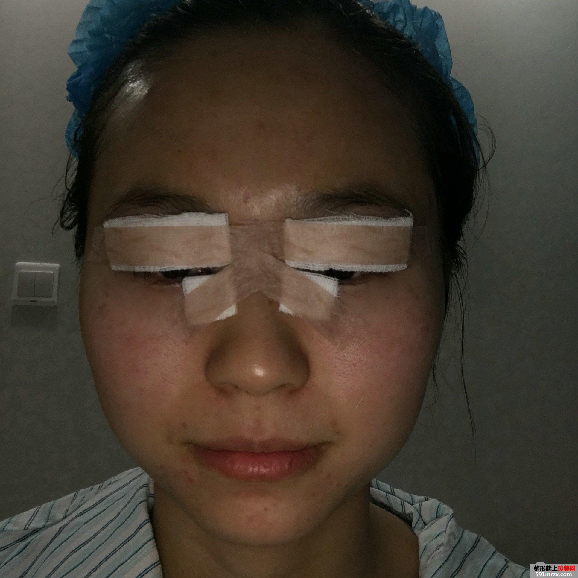 全切双眼皮+瘦脸针效果对比照片，真实案例分享