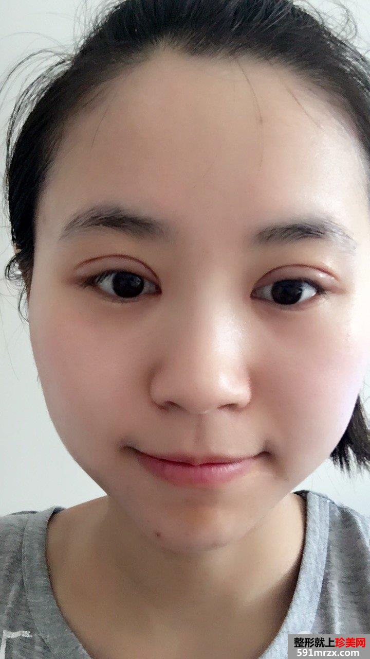 全切双眼皮+瘦脸针效果对比照片，真实案例分享