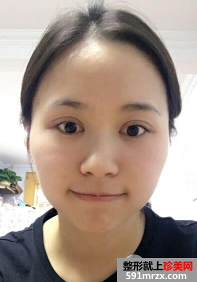全切双眼皮+瘦脸针效果对比照片，真实案例分享