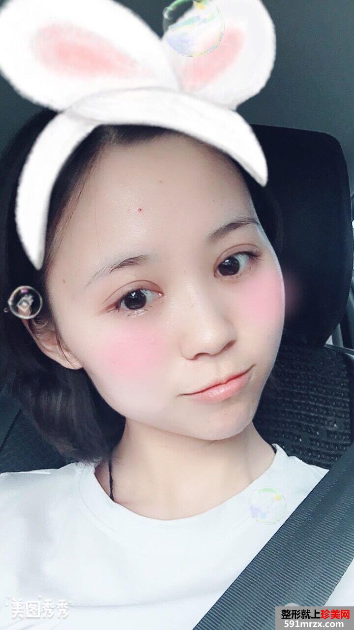 全切双眼皮+瘦脸针效果对比照片，真实案例分享