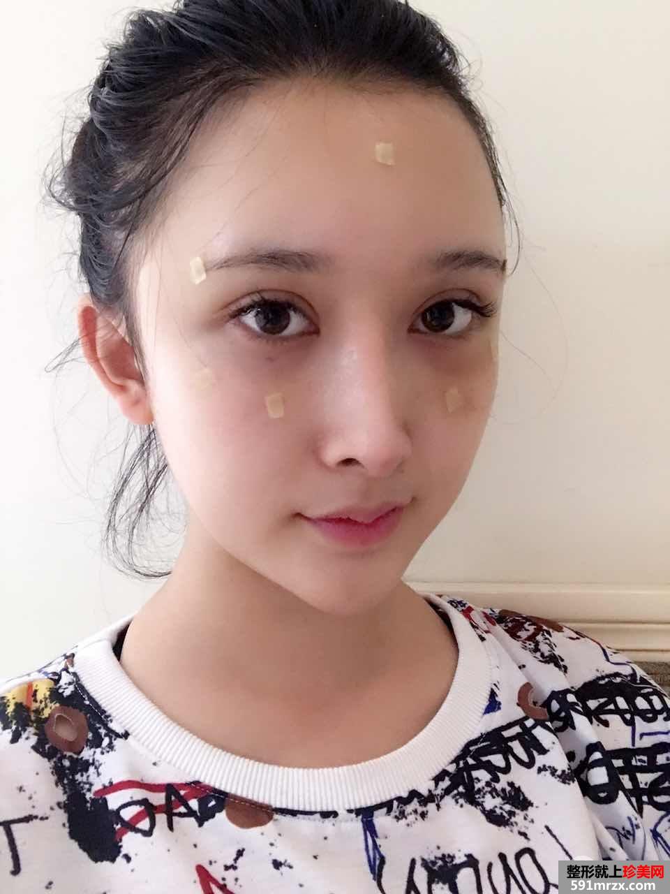 自体脂肪面部填充打造完美童颜，真人案例对比图分享