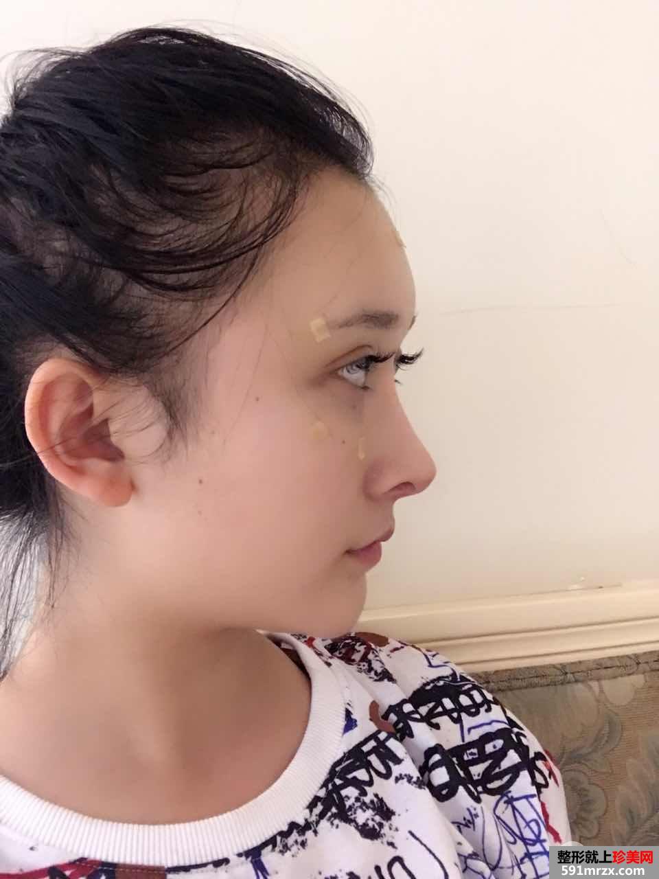 自体脂肪面部填充打造完美童颜，真人案例对比图分享