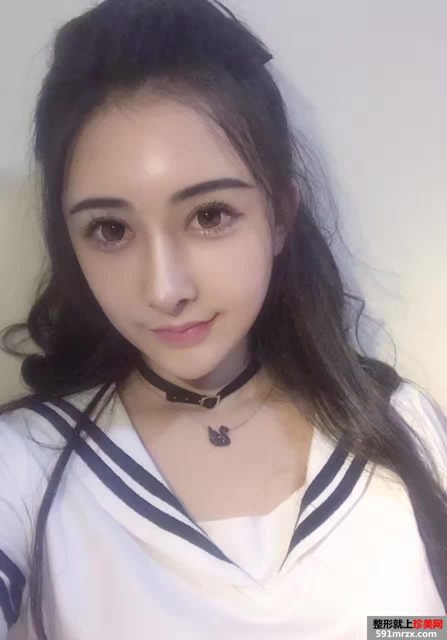 自体脂肪面部填充打造完美童颜，真人案例对比图分享