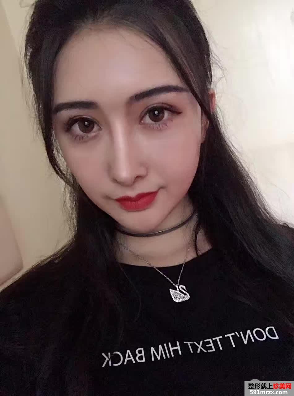 自体脂肪面部填充打造完美童颜，真人案例对比图分享