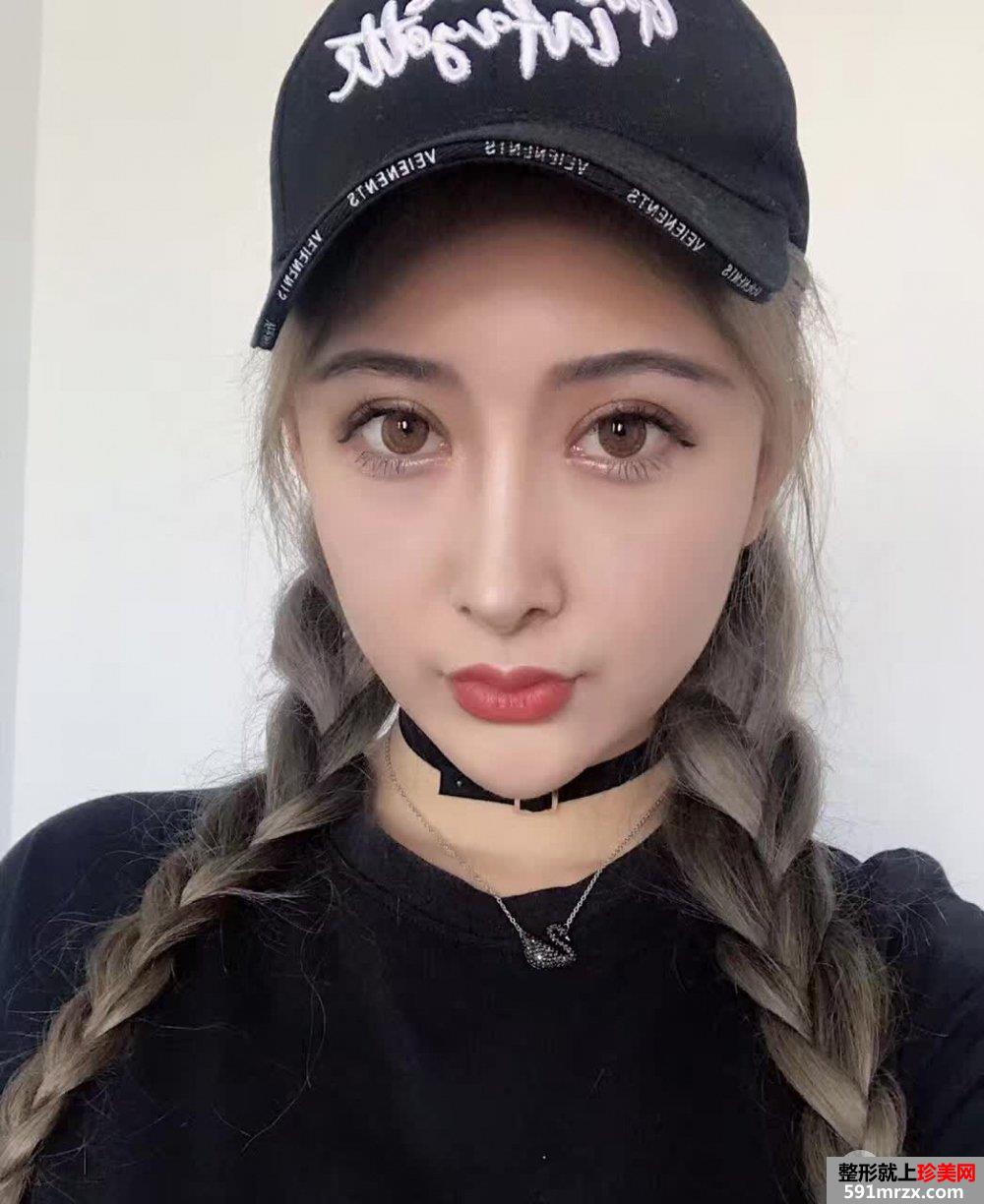自体脂肪面部填充打造完美童颜，真人案例对比图分享
