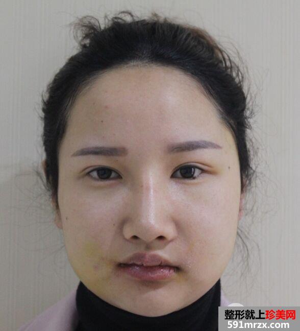 颧骨内推+下颌角切除手术真实案例 轻松变小V脸