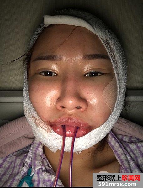 颧骨内推+下颌角切除手术真实案例 轻松变小V脸