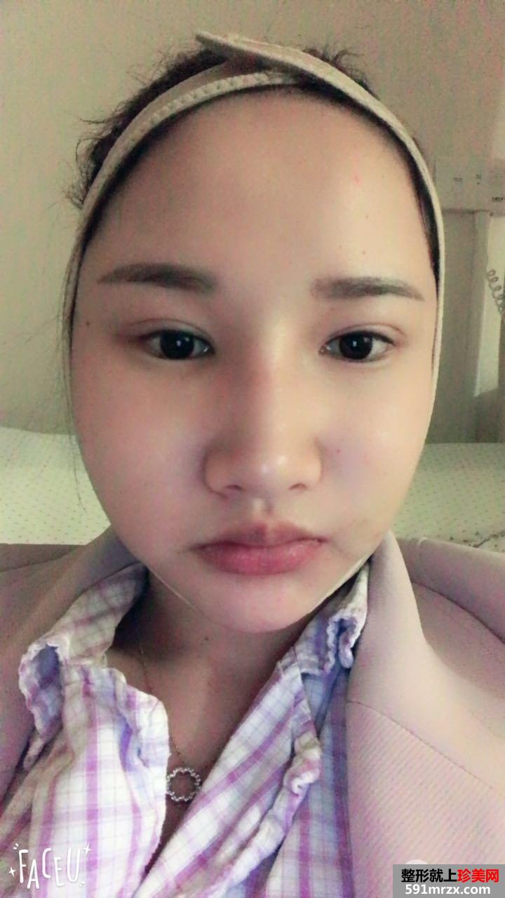 颧骨内推+下颌角切除手术真实案例 轻松变小V脸
