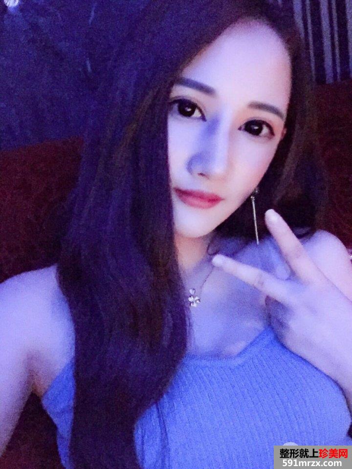颧骨内推+下颌角切除手术真实案例 轻松变小V脸