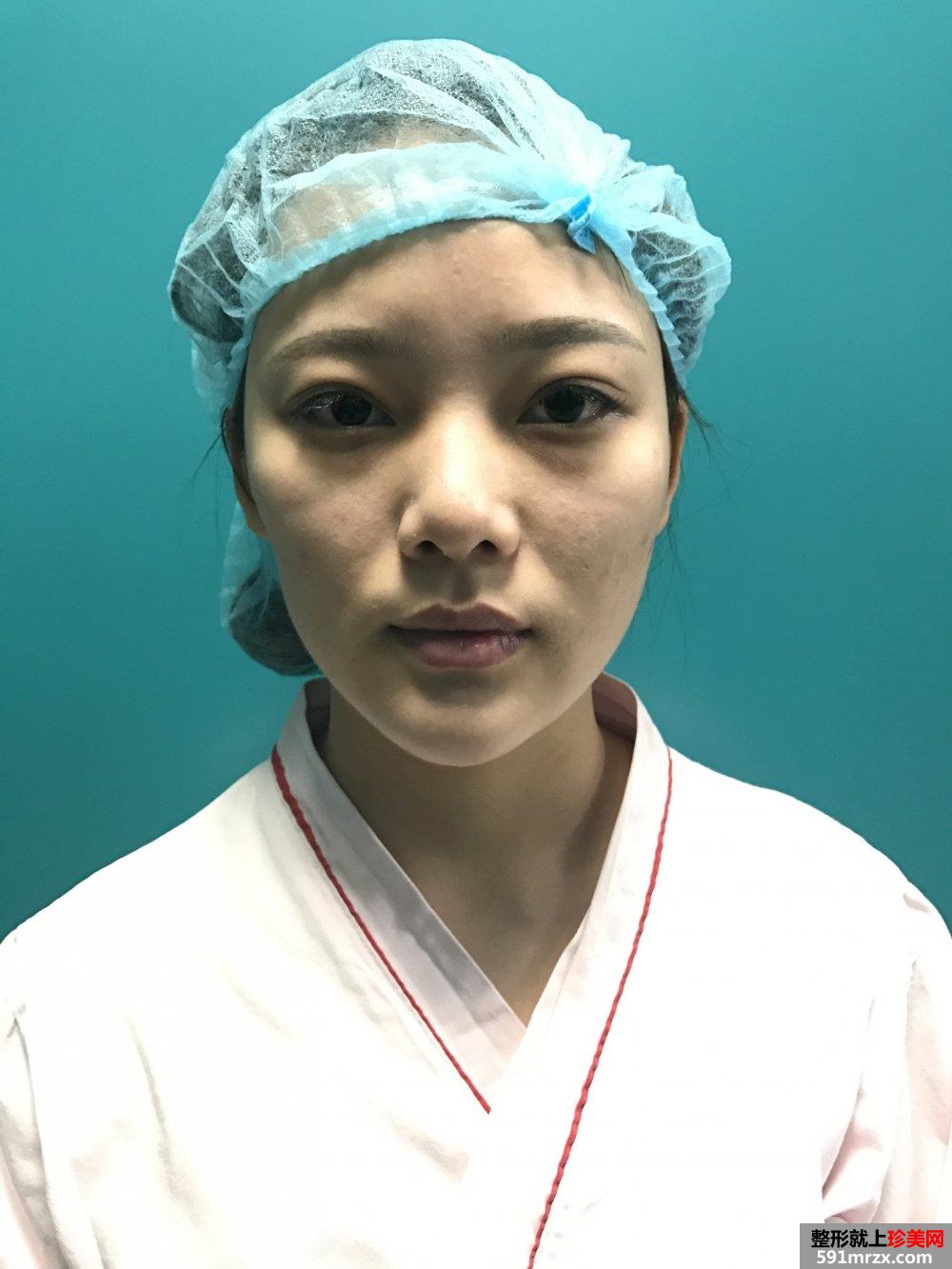 自体脂肪面部填充+假体隆鼻手术案例对比照片