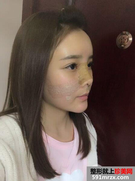 自体脂肪面部填充+假体隆鼻手术案例对比照片