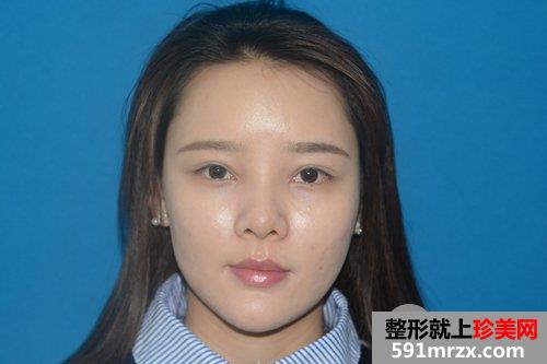 自体脂肪面部填充+假体隆鼻手术案例对比照片