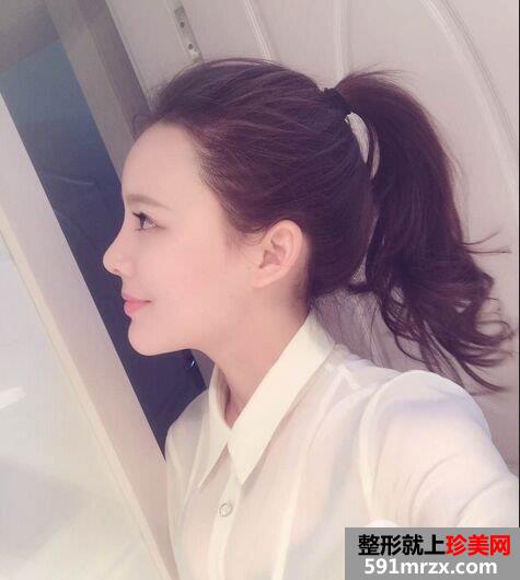 自体脂肪面部填充+假体隆鼻手术案例对比照片