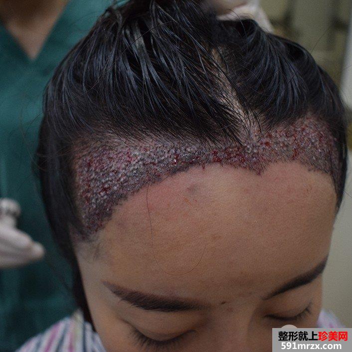 发际线移植调整真人图片 即刻拥有美人尖