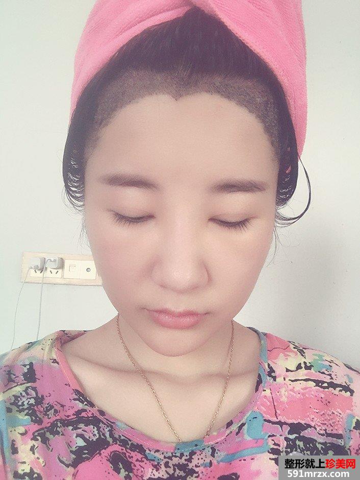 发际线移植调整真人图片 即刻拥有美人尖