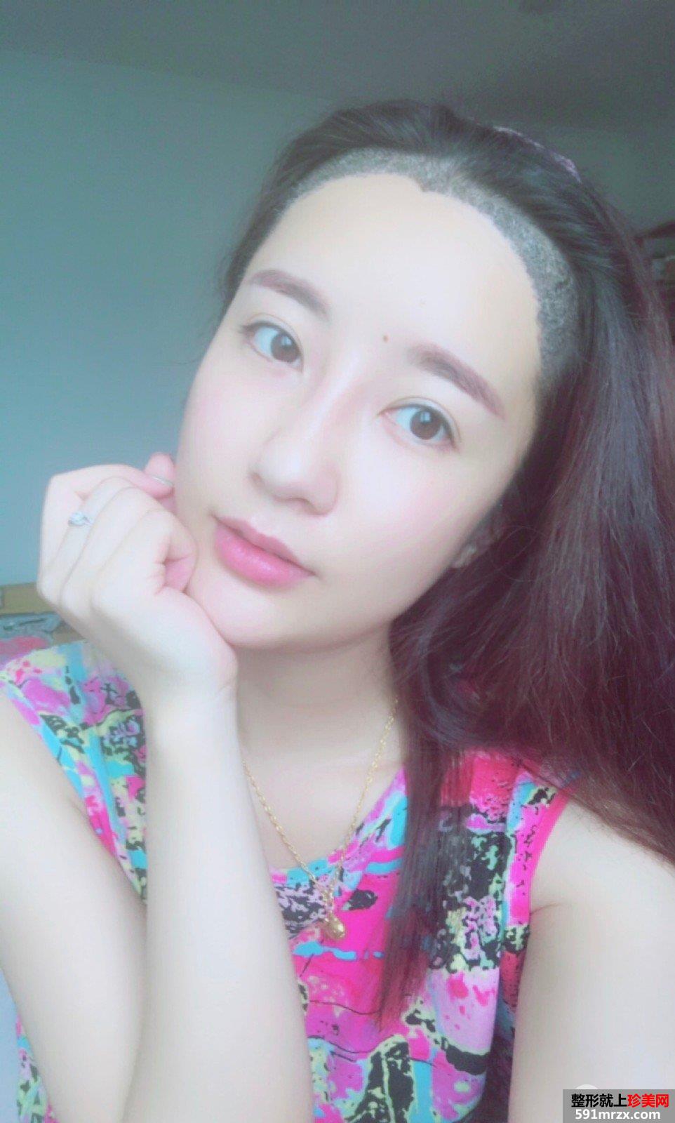 发际线移植调整真人图片 即刻拥有美人尖