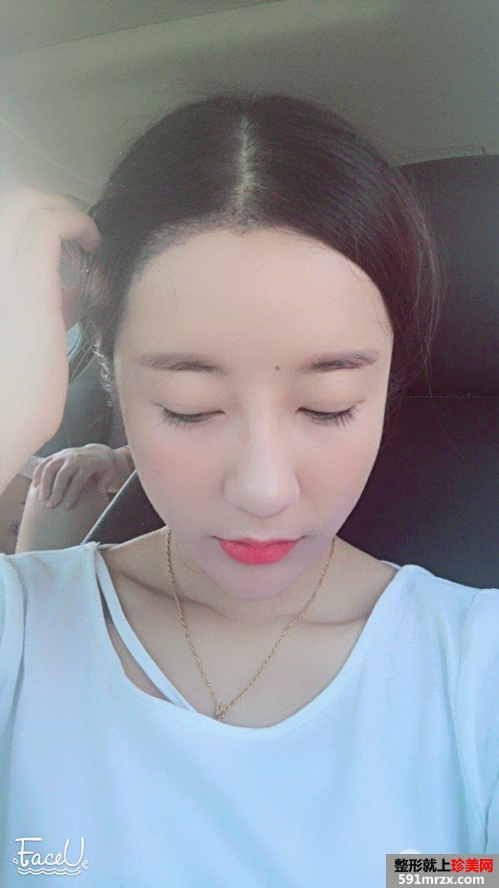 发际线移植调整真人图片 即刻拥有美人尖