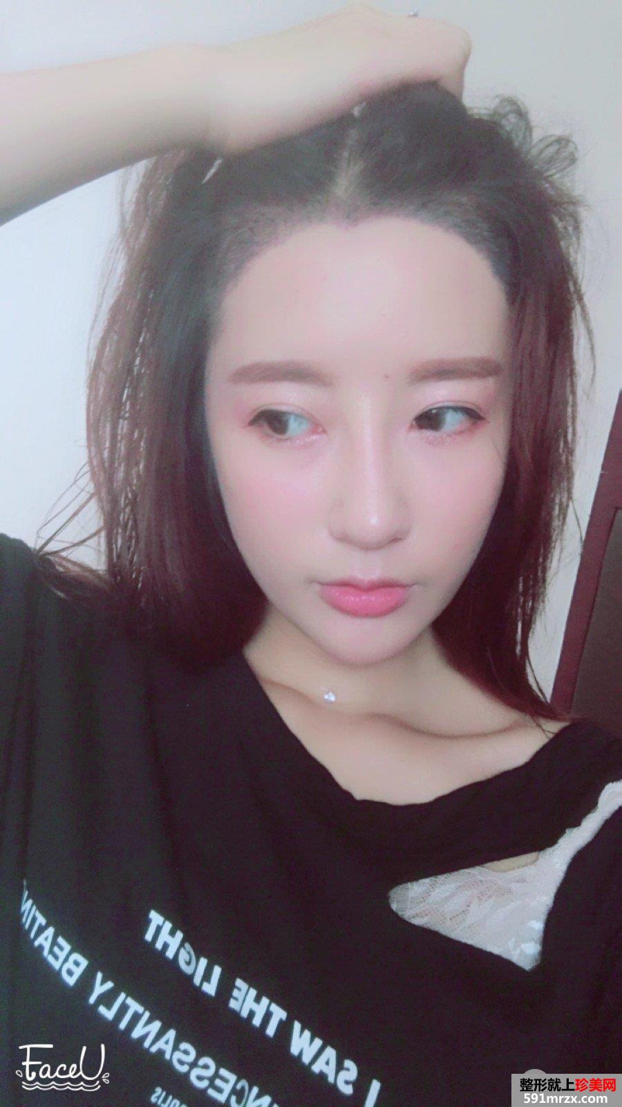 发际线移植调整真人图片 即刻拥有美人尖