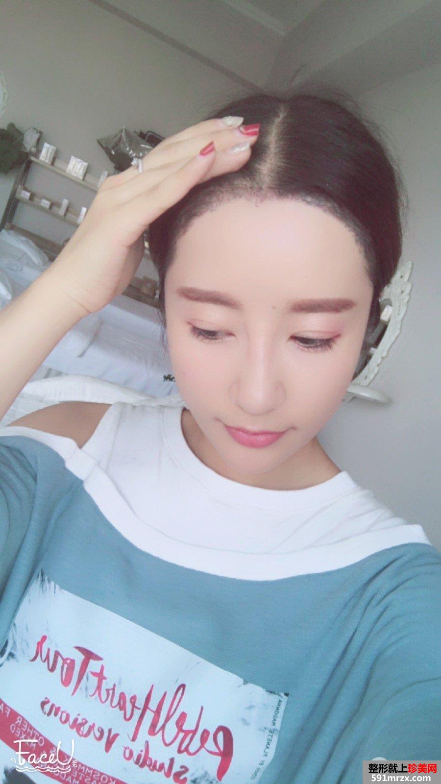 发际线移植调整真人图片 即刻拥有美人尖