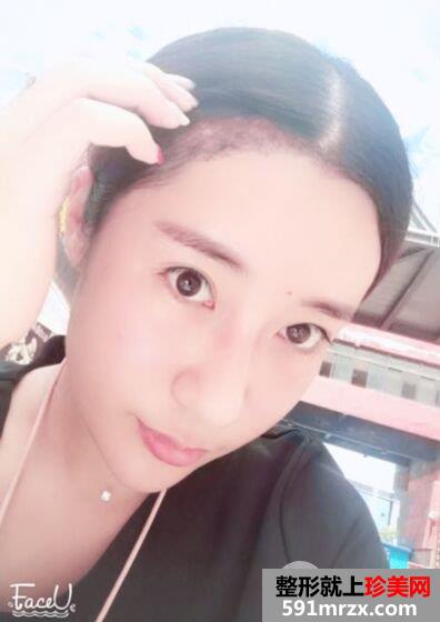 发际线移植调整真人图片 即刻拥有美人尖