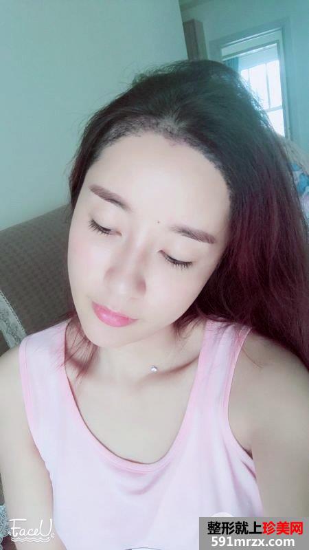 发际线移植调整真人图片 即刻拥有美人尖