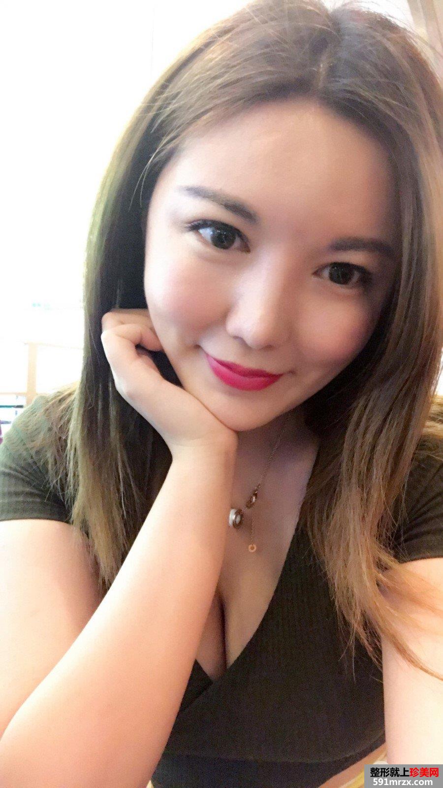 面部吸脂瘦脸真实案例分享，吸脂前后对比图