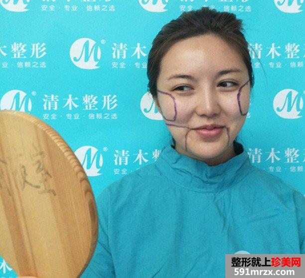 面部吸脂瘦脸真实案例分享，吸脂前后对比图
