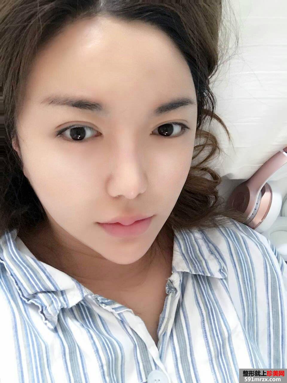 面部吸脂瘦脸真实案例分享，吸脂前后对比图