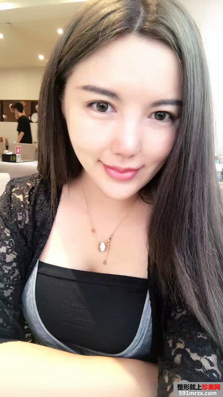 面部吸脂瘦脸真实案例分享，吸脂前后对比图