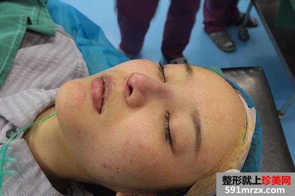 鼻综合整形真实恢复期图片，打造日系萌妹