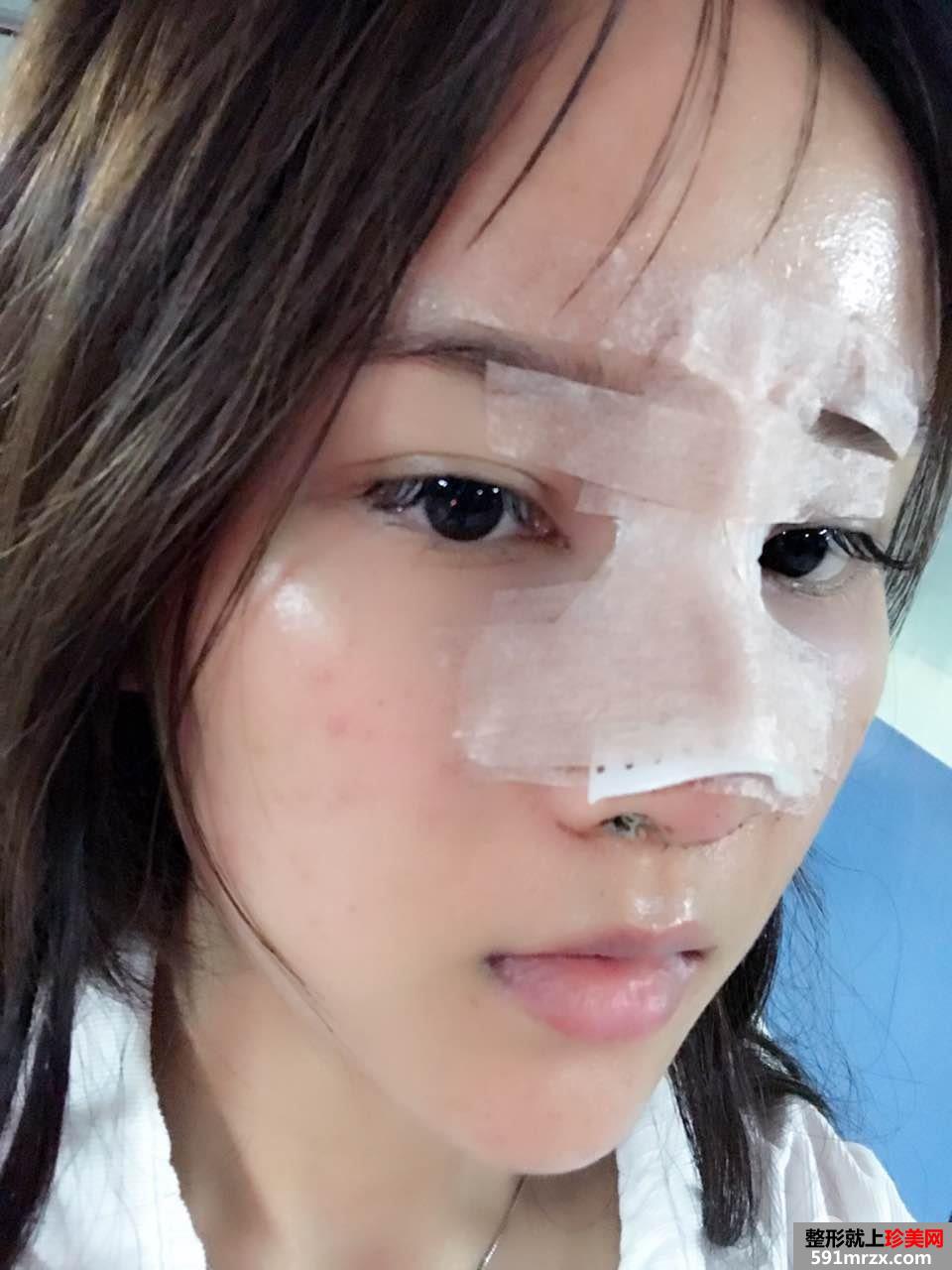 鼻综合整形真实恢复期图片，打造日系萌妹