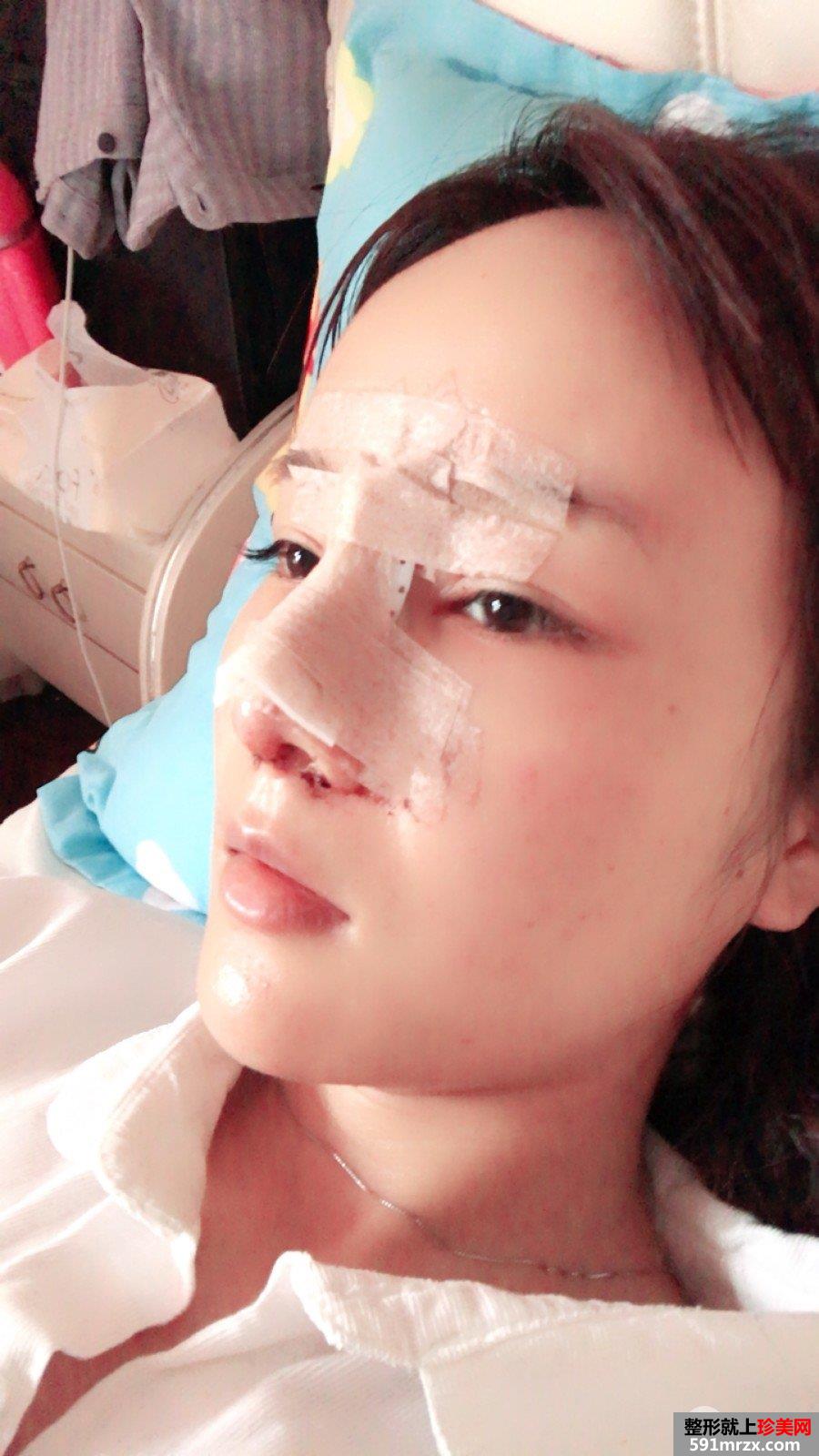 鼻综合整形真实恢复期图片，打造日系萌妹