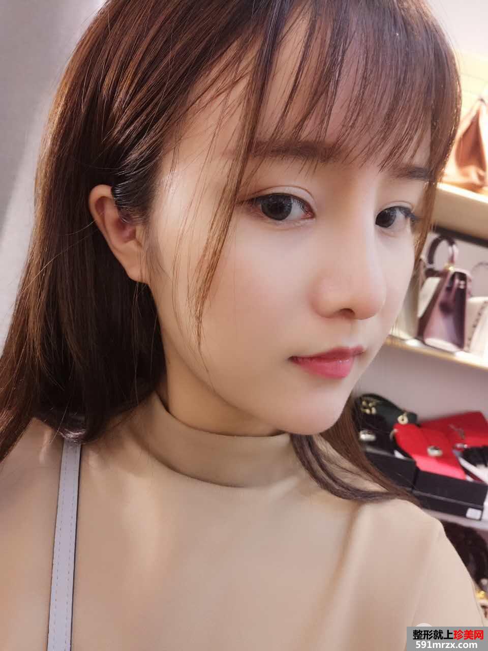 鼻综合整形真实恢复期图片，打造日系萌妹