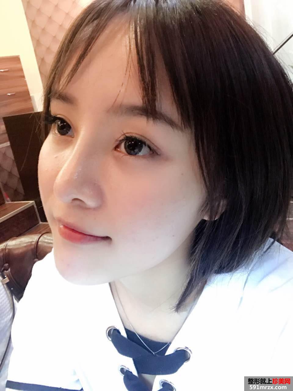 鼻综合整形真实恢复期图片，打造日系萌妹