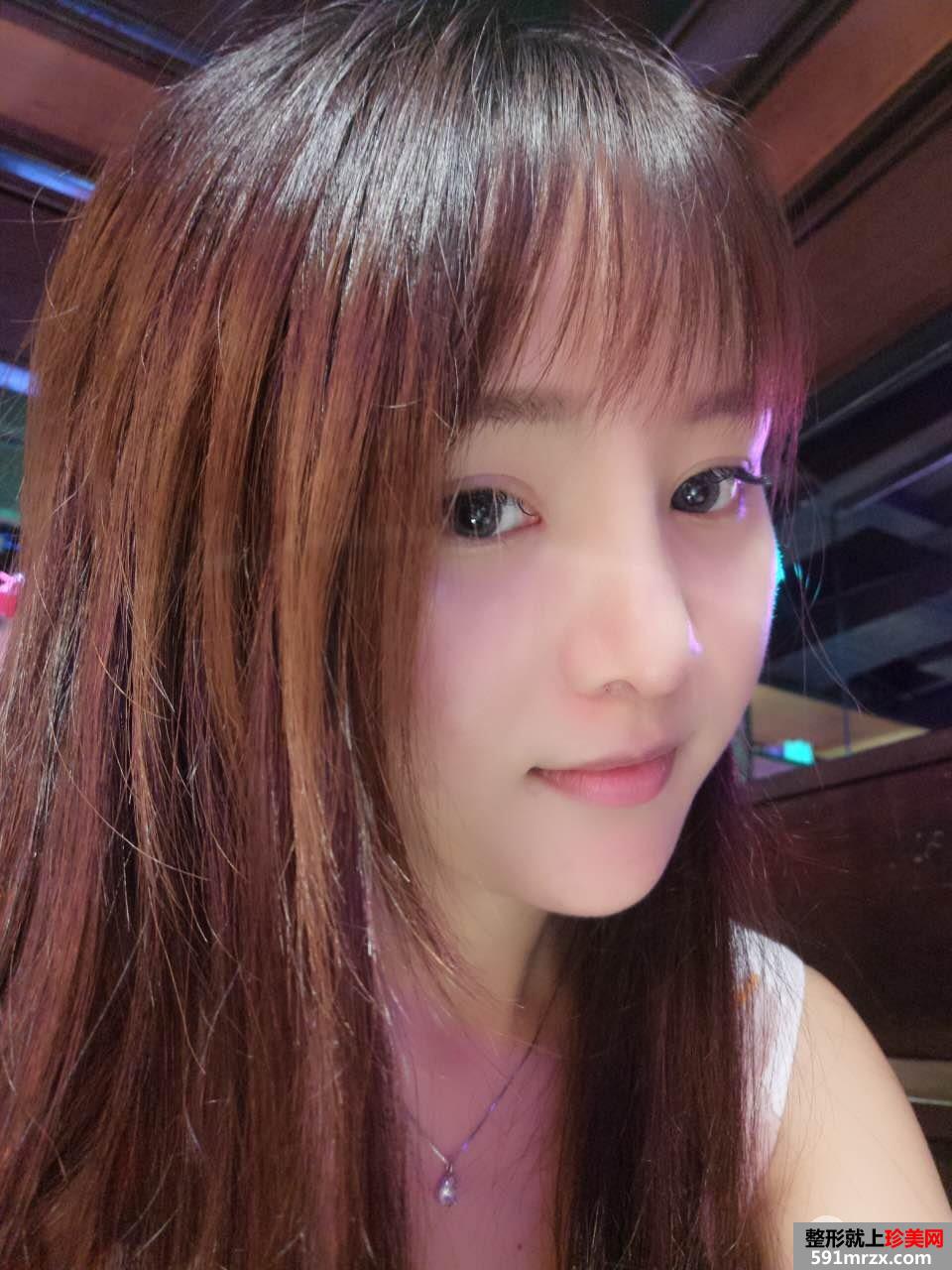 鼻综合整形真实恢复期图片，打造日系萌妹