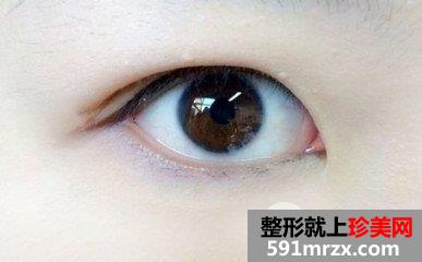 开眼角+双眼皮手术过程分享，还有很多术后效果图哦~